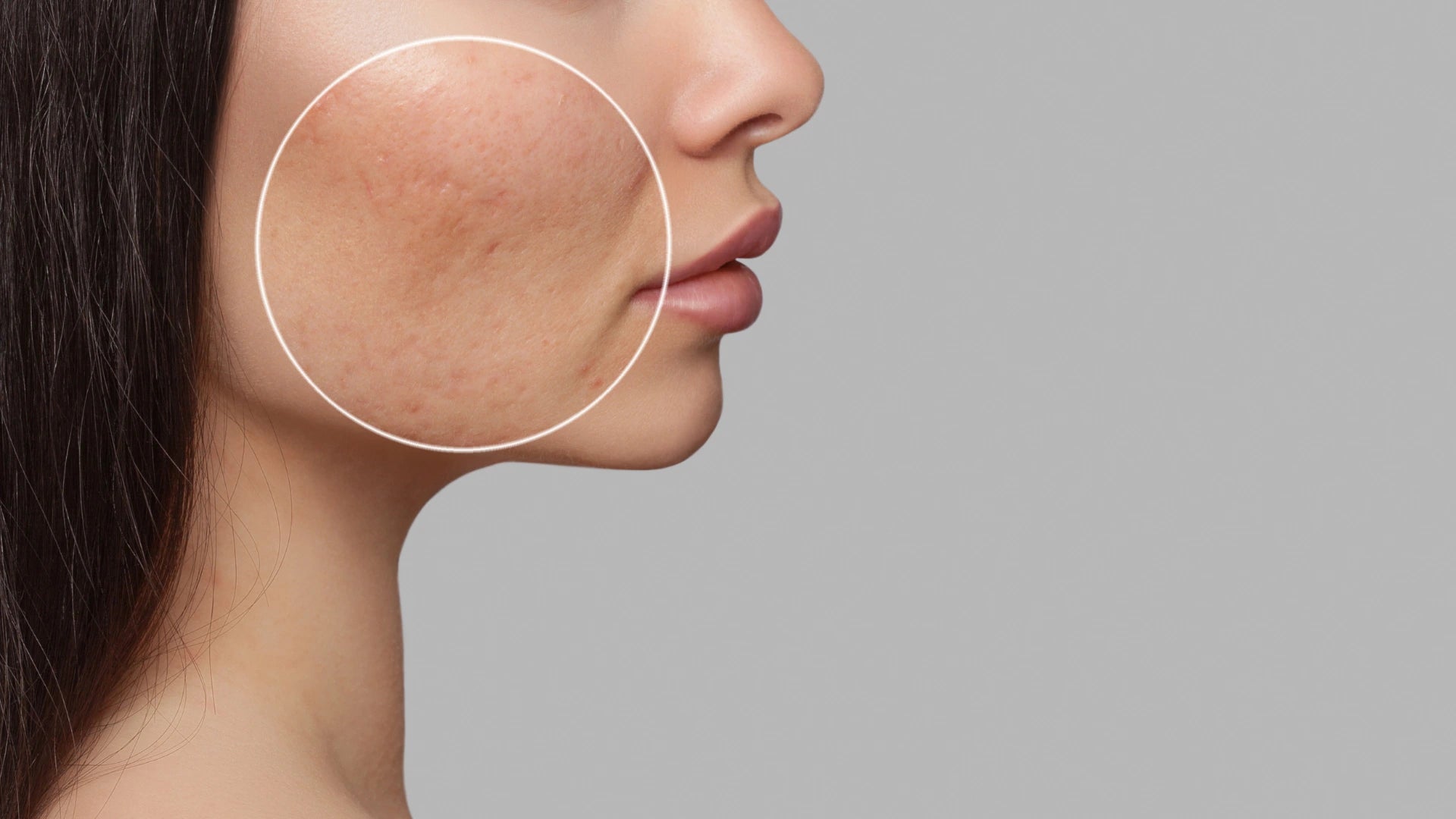 Clear Skin: Plexr’s Non-Invasive Approach to Active Acne and Scars with Tatiana Sarmiento Picture