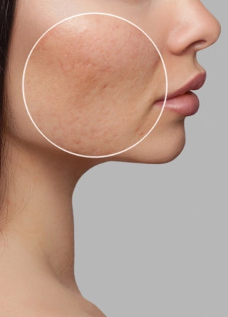 Clear Skin: Plexr’s Non-Invasive Approach to Active Acne and Scars with Tatiana Sarmiento Workshop Picture