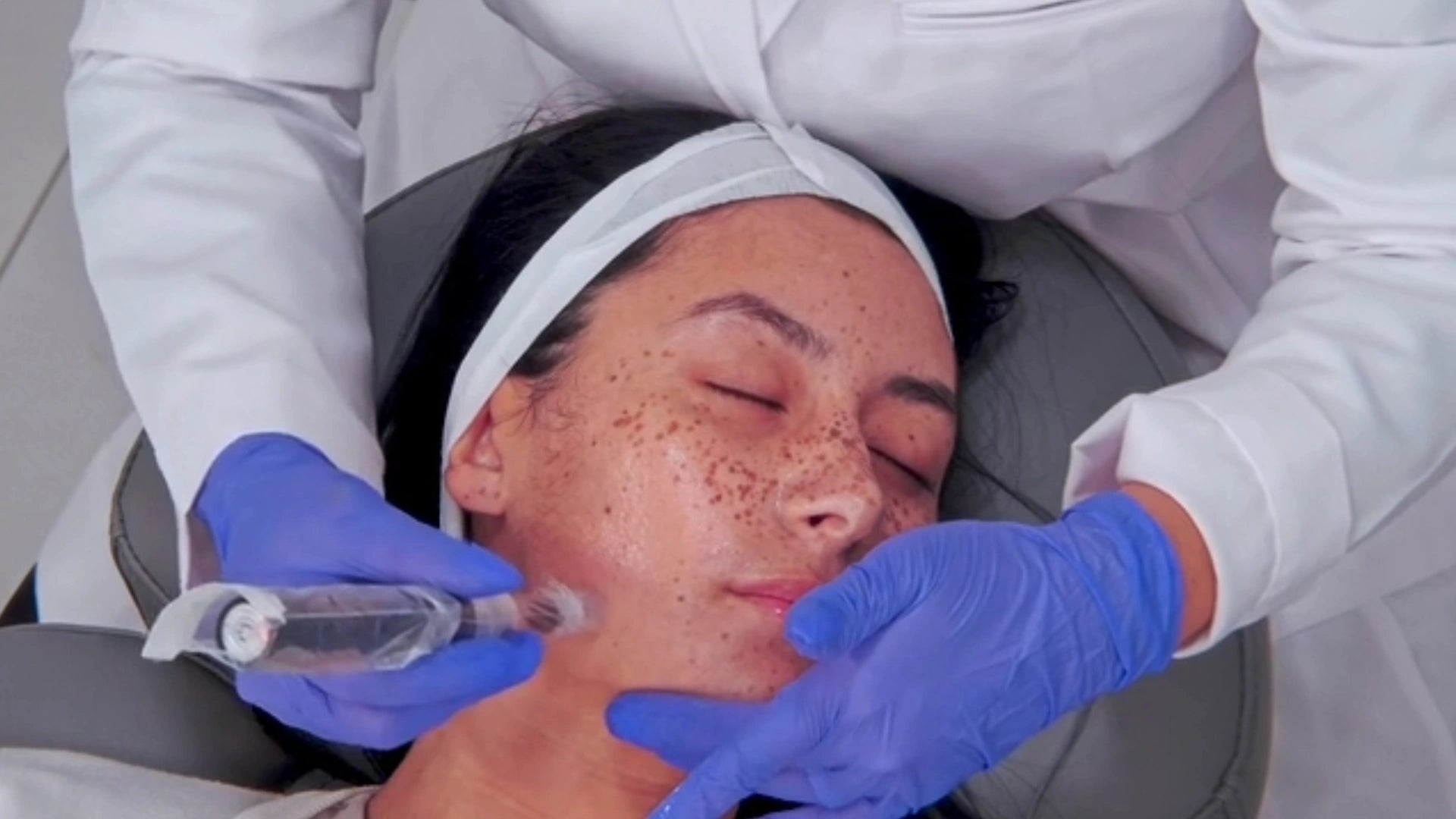 Microneedling Picture